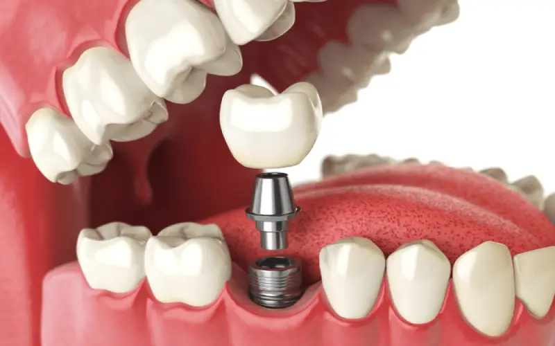 Prepare for Dental Implants in Beverly Hills