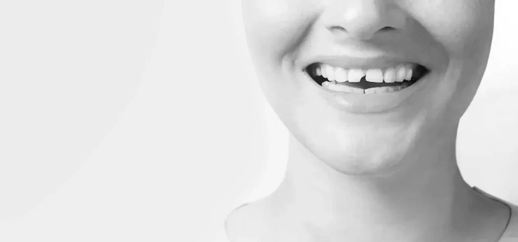 Broken Tooth Dentist in Beverly Hills