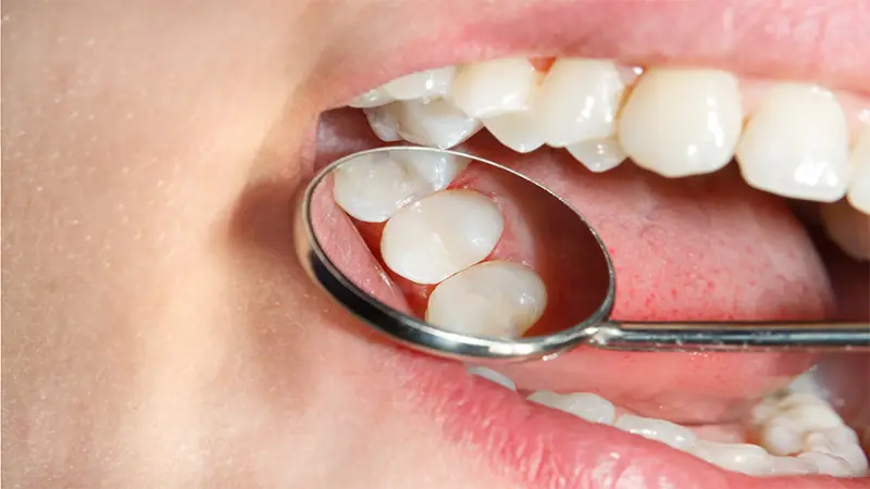 White, Tooth Colored Filling – FAQ