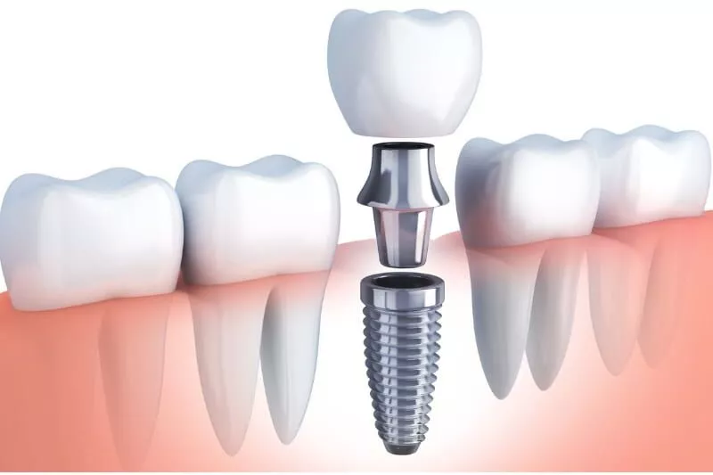 How do Dental Implants Feel and Am I a Candidate?