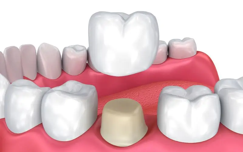 Dental Crowns Treatment – What to Expect