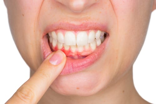 How to Treat Tooth Decay at the Gum Line
