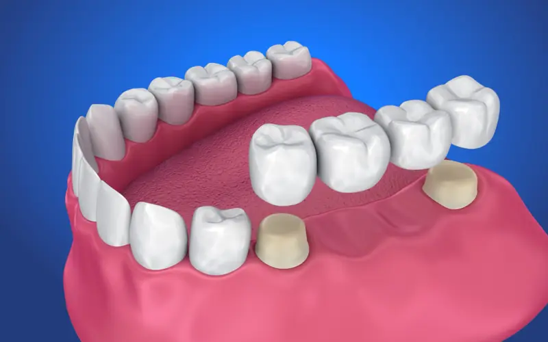 What to Expect with Dental Bridges