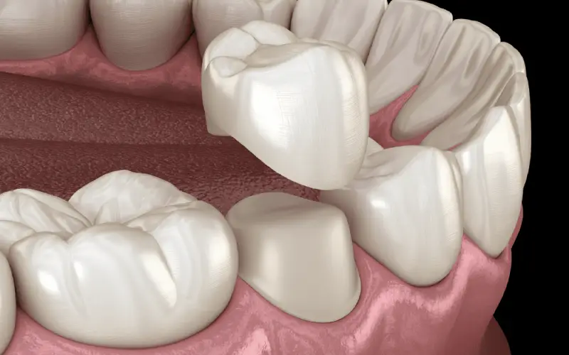 Dental Crowns – Your First Visit | Beverly Hills CA