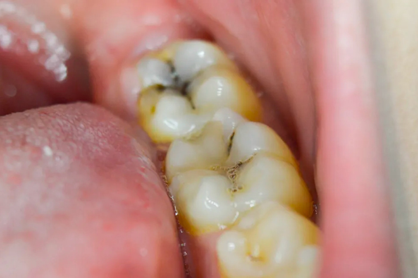 Cavity Fillings in Beverly Hills