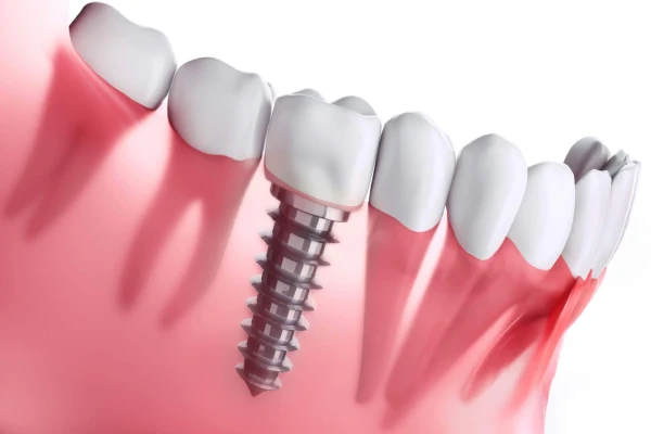 Innovations Shaping the Future of Implants in Beverly Hills