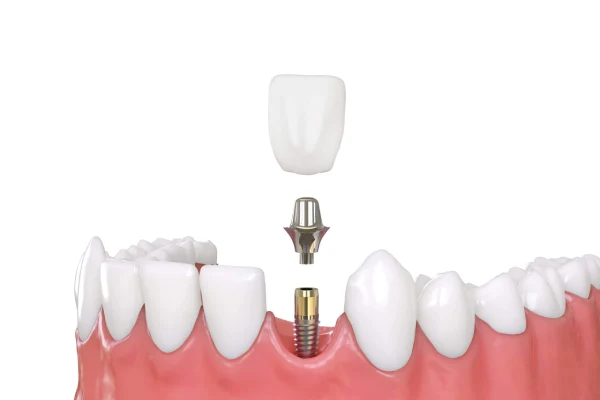 Dispelling Doubts: Common Myths About Dental Implants