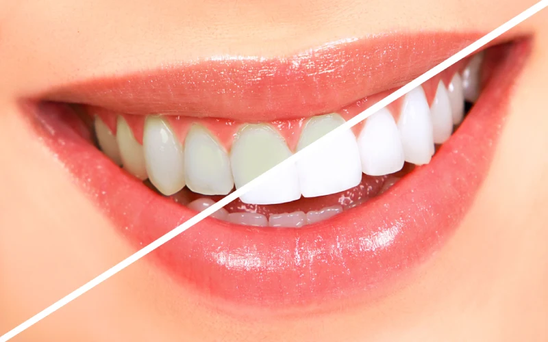 Top Teeth Whitening Options