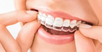 invisalign